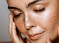 Hiperpigmentaciones y pecas. ¿Amarlas o eliminarlas?