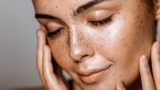 Hiperpigmentaciones y pecas. ¿Amarlas o eliminarlas?